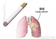 肺癌晚期的最佳治疗,优化生存质量与延长生命